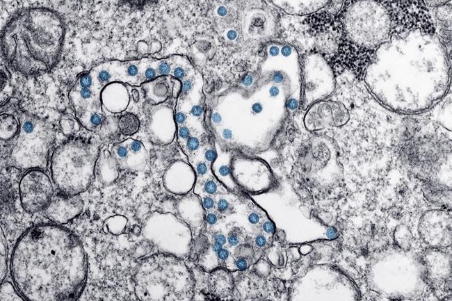 This 2020 electron microscope image made available by the U.S. Centers for Disease Control and Prevention shows the spherical particles of the new coronavirus, colorized blue, from the first U.S. case of COVID-19. THE CANADIAN PRESS/Hannah A. Bullock, Azaibi Tamin/CDC via AP