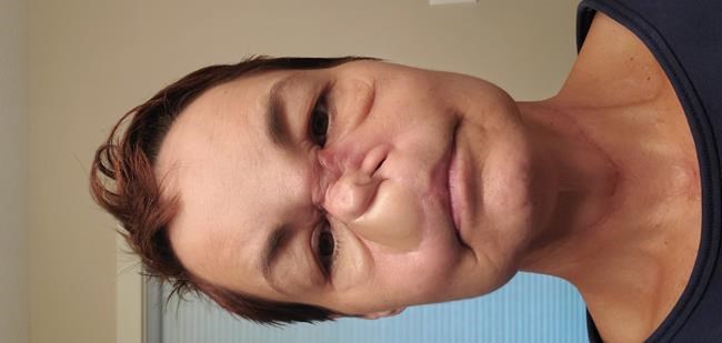 Sharon Durham of Wynyard, Sask., is seen in an undated handout photo. Durham says she is worried she will lose her eyesight or possibly die after a surgery scheduled in Edmonton for a rare cancer in her face was cancelled because she's not a resident of the province where hospitals are overwhelmed by COVID-19. THE CANADIAN PRESS/HO-Sharon Durham, *MANDATORY CREDIT*
