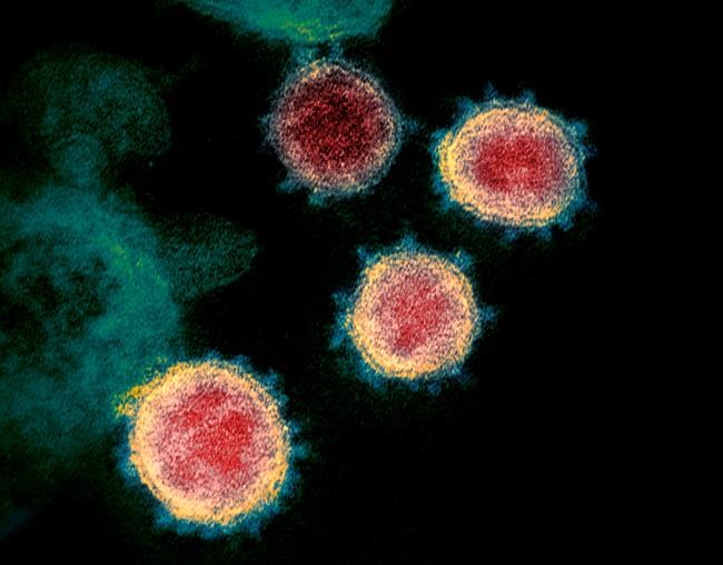 This undated electron microscope image made available by the U.S. National Institutes of Health in February 2020 shows the virus that causes COVID-19. The sample was isolated from a patient in the U.S. THE CANADIAN PRESS/NIAID-RML via AP
