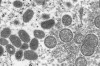 This 2003 electron microscope image made available by the Centers for Disease Control and Prevention shows mature, oval-shaped monkeypox virions, left, and spherical immature virions, right, obtained from a sample of human skin associated with the 2003 prairie dog outbreak. Some provinces say they're keeping watch for monkeypox as Montreal officials investigate 17 suspected cases in the region.THE CANADIAN PRESS/Cynthia S. Goldsmith, Russell Regner-CDC via AP